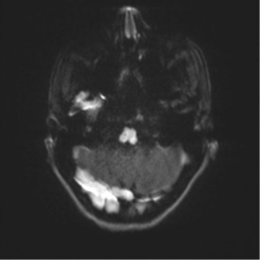Cerebellar agenesis with hypoplastic pons (pontocerebellar hypoplasia) (Radiopaedia 57224-64138 Axial DWI 46).png