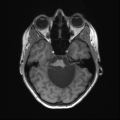 File:Cerebellar agenesis with hypoplastic pons (pontocerebellar hypoplasia) (Radiopaedia 57224-64138 Axial T1 25).png