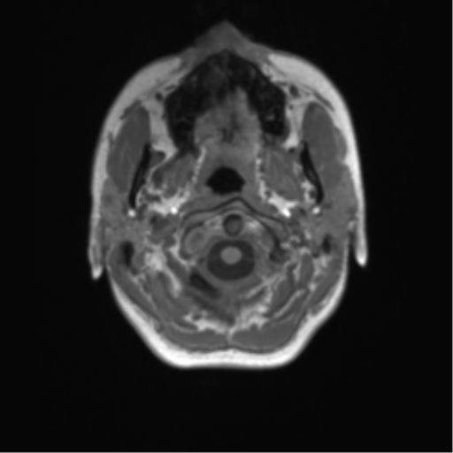 File:Cerebellar agenesis with hypoplastic pons (pontocerebellar hypoplasia) (Radiopaedia 57224-64138 Axial T1 6).png