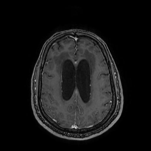 File:Cerebellar hemangioblastoma (Radiopaedia 88055-104622 Axial T1 C+ 124).jpg