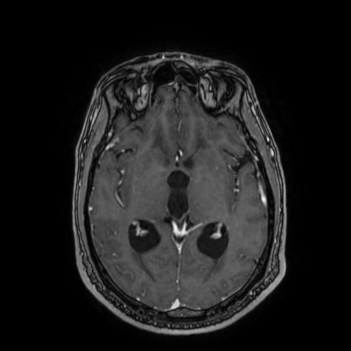 Cerebellar hemangioblastoma (Radiopaedia 88055-104622 Axial T1 C+ 93).jpg