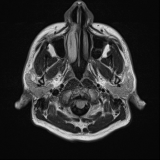 File:Cerebellar hemangioblastomas and pituitary adenoma (Radiopaedia 85490-101176 Axial FLAIR 2).png