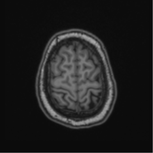 File:Cerebellar hemangioblastomas and pituitary adenoma (Radiopaedia 85490-101176 Axial T1 63).png