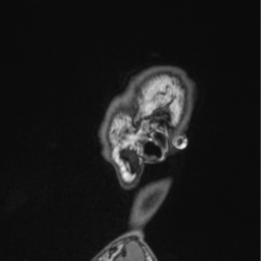 Cerebellar hemangioblastomas and pituitary adenoma (Radiopaedia 85490-101176 Sagittal T1 17).png