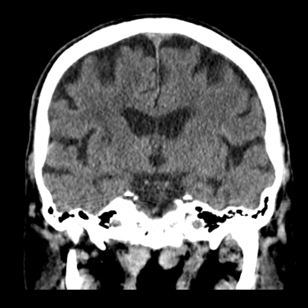 Cerebellar hemorrhage (Radiopaedia 27193-27359 Coronal non-contrast 30).jpg