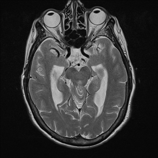 File:Cerebellar metastases (Radiopaedia 24038-24249 Axial T2 3).jpg