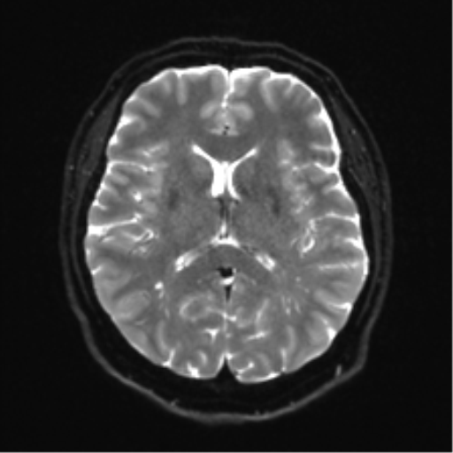 Cerebellopontine angle meningioma (Radiopaedia 48434-53348 Axial DWI 22).png