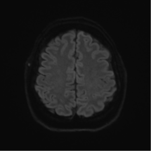 Cerebellopontine angle meningioma (Radiopaedia 48434-53348 Axial DWI 66).png