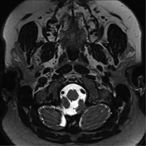Cerebellopontine angle meningioma (Radiopaedia 48434-53348 Axial T2 Space 3).png