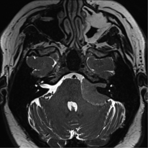 Cerebellopontine angle meningioma (Radiopaedia 48434-53348 Axial T2 Space 58).png