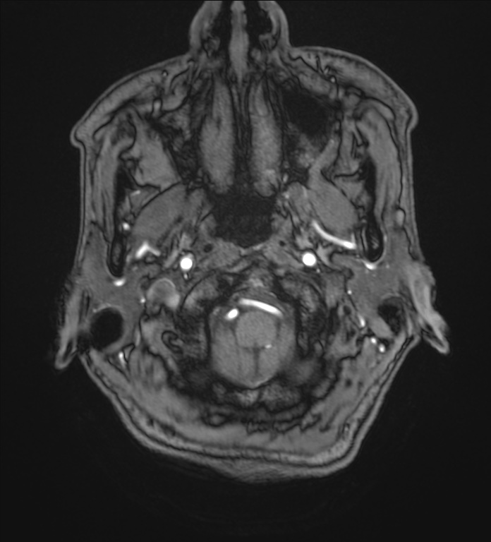 Cerebellopontine angle meningioma (Radiopaedia 72983-83680 Axial MRA 1).jpg