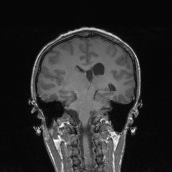 Cerebral abscess (Radiopaedia 24212-24478 Coronal T1 127).jpg