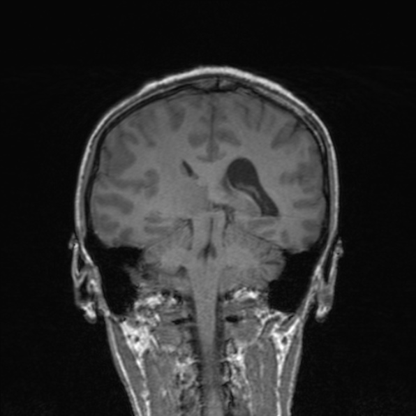 Cerebral abscess (Radiopaedia 24212-24478 Coronal T1 133).jpg