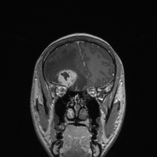 Cerebral abscess (Radiopaedia 24212-24478 Coronal T1 C+ 67).jpg