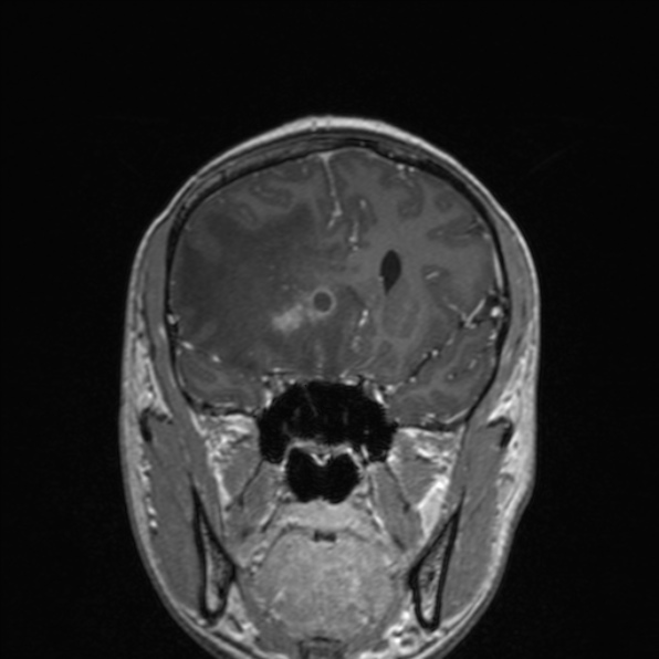 Cerebral abscess (Radiopaedia 24212-24478 Coronal T1 C+ 83).jpg