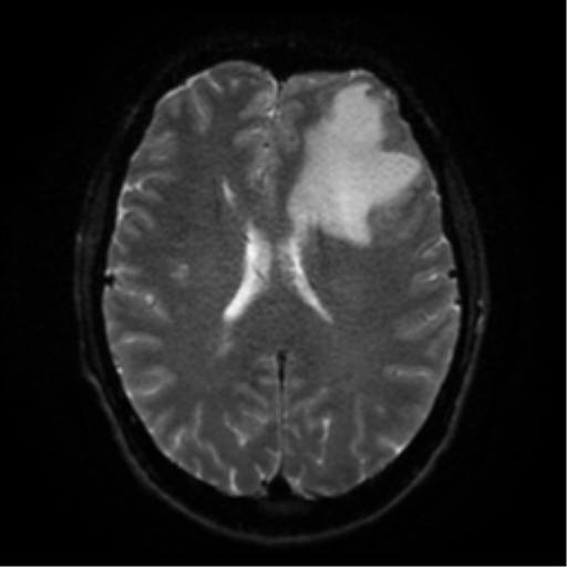 Cerebral abscess (Radiopaedia 57774-64740 Axial DWI 46).png