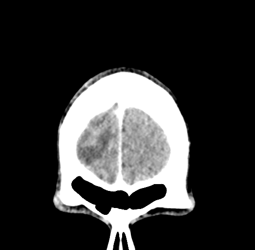 File:Cerebral abscess (Radiopaedia 60342-68008 Coronal C+ delayed 7).png