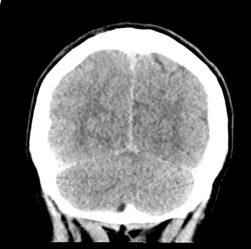 Cerebral abscess (Radiopaedia 60342-68008 Coronal non-contrast 52).png