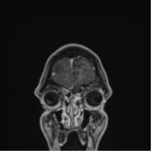 Cerebral abscess (Radiopaedia 60342-68009 H 51).png