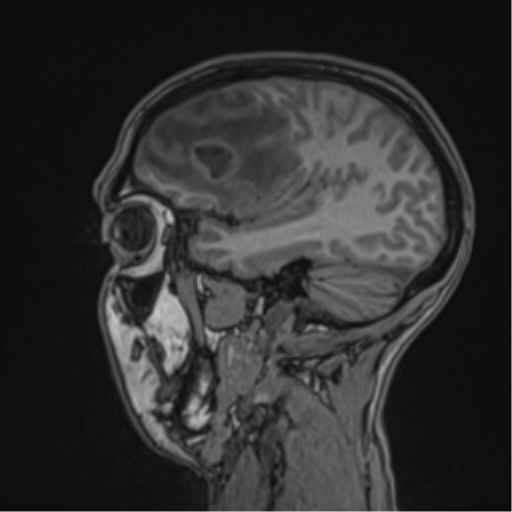 Cerebral abscess (Radiopaedia 60342-68009 Sagittal T1 42).png