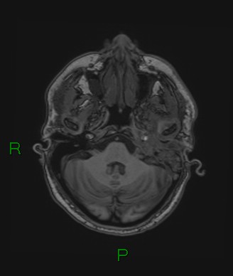 File:Cerebral abscess and subdural empyema (Radiopaedia 84436-99779 Axial T1 67).jpg