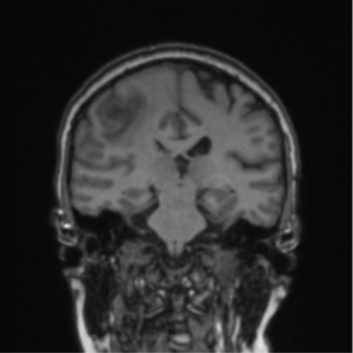 File:Cerebral abscess from pulmonary arteriovenous malformation (Radiopaedia 86275-102291 Coronal T1 41).png