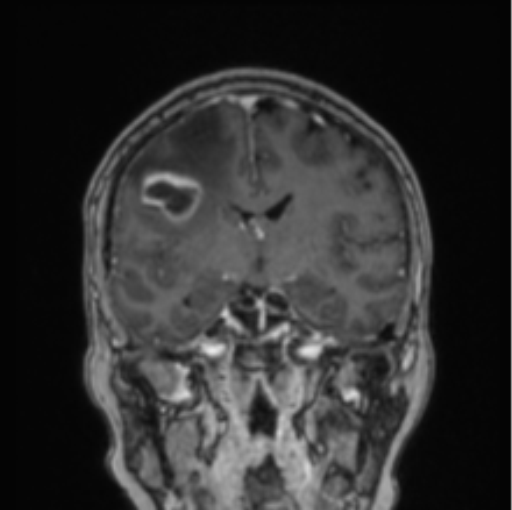 Cerebral abscess from pulmonary arteriovenous malformation (Radiopaedia 86275-102291 L 49).png