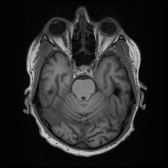 File:Cerebral abscess with ventriculitis (Radiopaedia 78965-91878 Axial T1 16).jpg