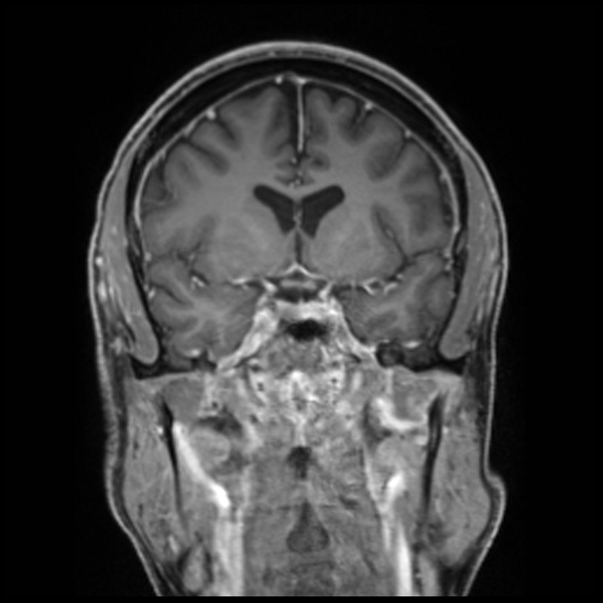 Cerebral abscess with ventriculitis (Radiopaedia 78965-91878 Coronal T1 C+ 27).jpg