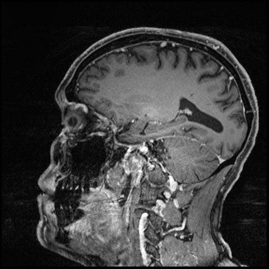 Cerebral abscess with ventriculitis (Radiopaedia 78965-91878 Sagittal T1 C+ 118).jpg