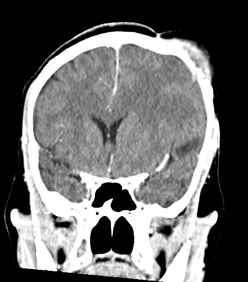 File:Cerebral abscesses (Radiopaedia 70458-80568 Coronal Contrast 26).jpg