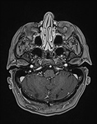 Cerebral amyloid angiopathy-related inflammation (Radiopaedia 58270-65377 Axial T1 C+ fat sat 19).jpg