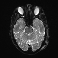 Cerebral amyloid angiopathy-related inflammation (Radiopaedia 74836-85849 Axial DWI 10).jpg