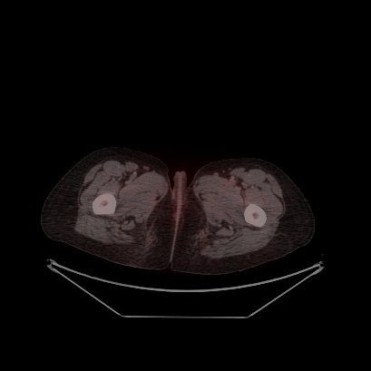 Cerebral and abdominal tuberculosis (Radiopaedia 90499-107853 C 254).jpg