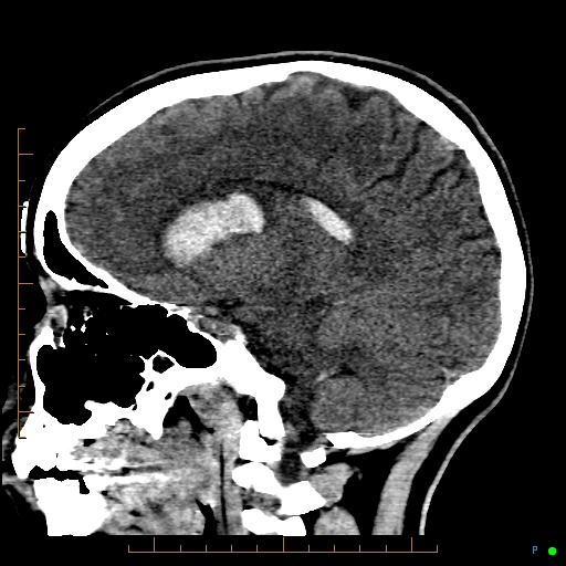File:Cerebral arteriovenous malformation (AVM) (Radiopaedia 78162-90706 A 34).jpg