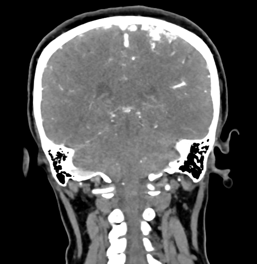 Cerebral arteriovenous malformation (Radiopaedia 73830-84645 C 65).jpg