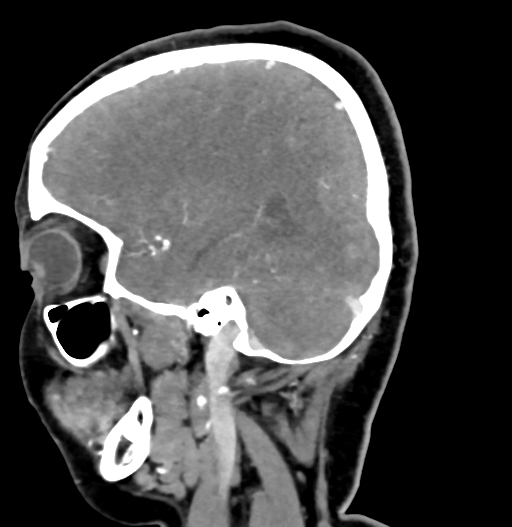 Cerebral arteriovenous malformation (Radiopaedia 73830-84645 D 28).jpg