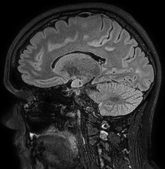 Cerebral arteriovenous malformation (Radiopaedia 74411-85654 Sagittal FLAIR 48).jpg