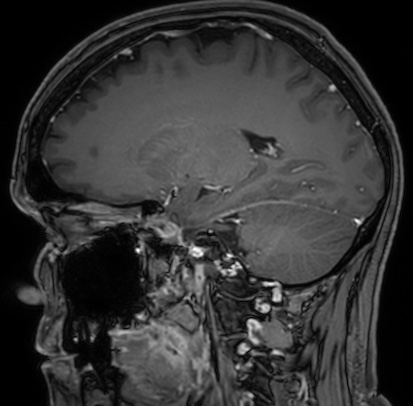 Cerebral arteriovenous malformation (Radiopaedia 74411-85654 Sagittal T1 C+ 49).jpg