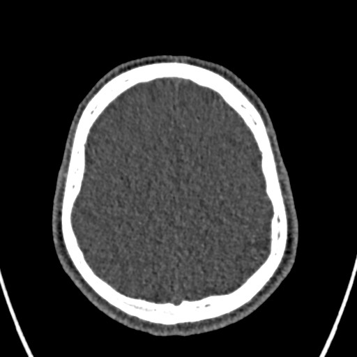 Cerebral arteriovenous malformation (Radiopaedia 78188-90746 Axial non-contrast 140).jpg