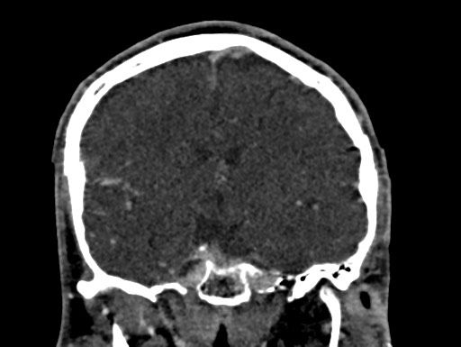 Cerebral arteriovenous malformation (Radiopaedia 78188-90746 Coronal C+ delayed 55).jpg