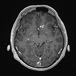 Cerebral arteriovenous malformation (Radiopaedia 84015-99245 Axial T1 C+ 70).jpg