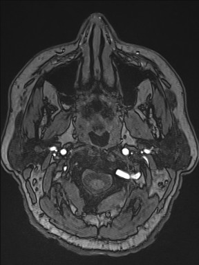 File:Cerebral arteriovenous malformation (Radiopaedia 84015-99245 Axial TOF 9).jpg