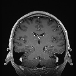 Cerebral arteriovenous malformation (Radiopaedia 84015-99245 Coronal T1 C+ 93).jpg