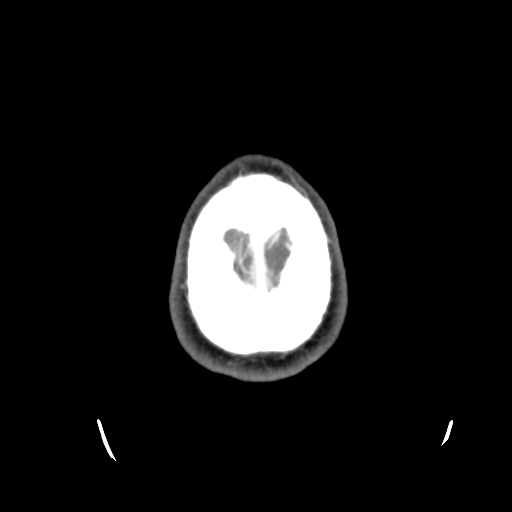 Cerebral arteriovenous malformation (Spetzler-Martin grade 2) (Radiopaedia 41262-44076 Axial C+ 50).png