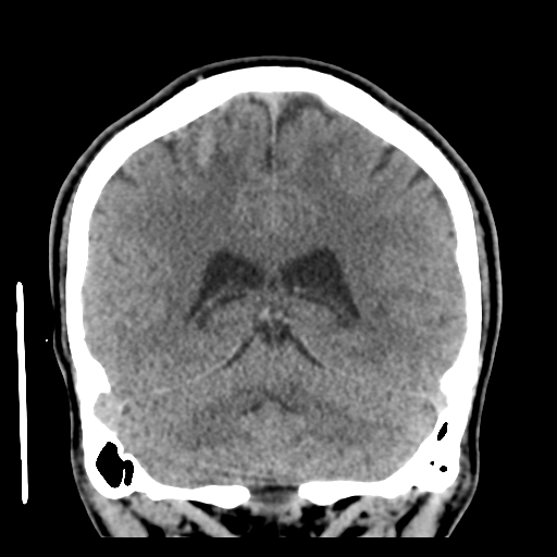 Cerebral arteriovenous malformation (Spetzler-Martin grade 2) (Radiopaedia 41262-44076 Coronal non-contrast 43).png