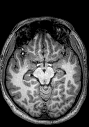 Cerebral arteriovenous malformation at posterior body of corpus callosum (Radiopaedia 74111-84925 Axial T1 181).jpg