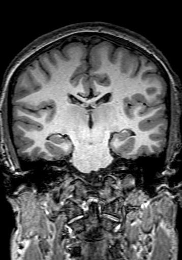 Cerebral arteriovenous malformation at posterior body of corpus callosum (Radiopaedia 74111-84925 Coronal T1 187).jpg