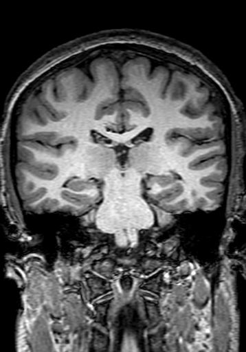 Cerebral arteriovenous malformation at posterior body of corpus callosum (Radiopaedia 74111-84925 Coronal T1 197).jpg