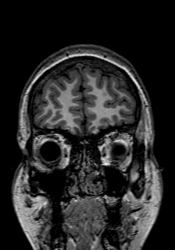 Cerebral arteriovenous malformation at posterior body of corpus callosum (Radiopaedia 74111-84925 Coronal T1 26).jpg